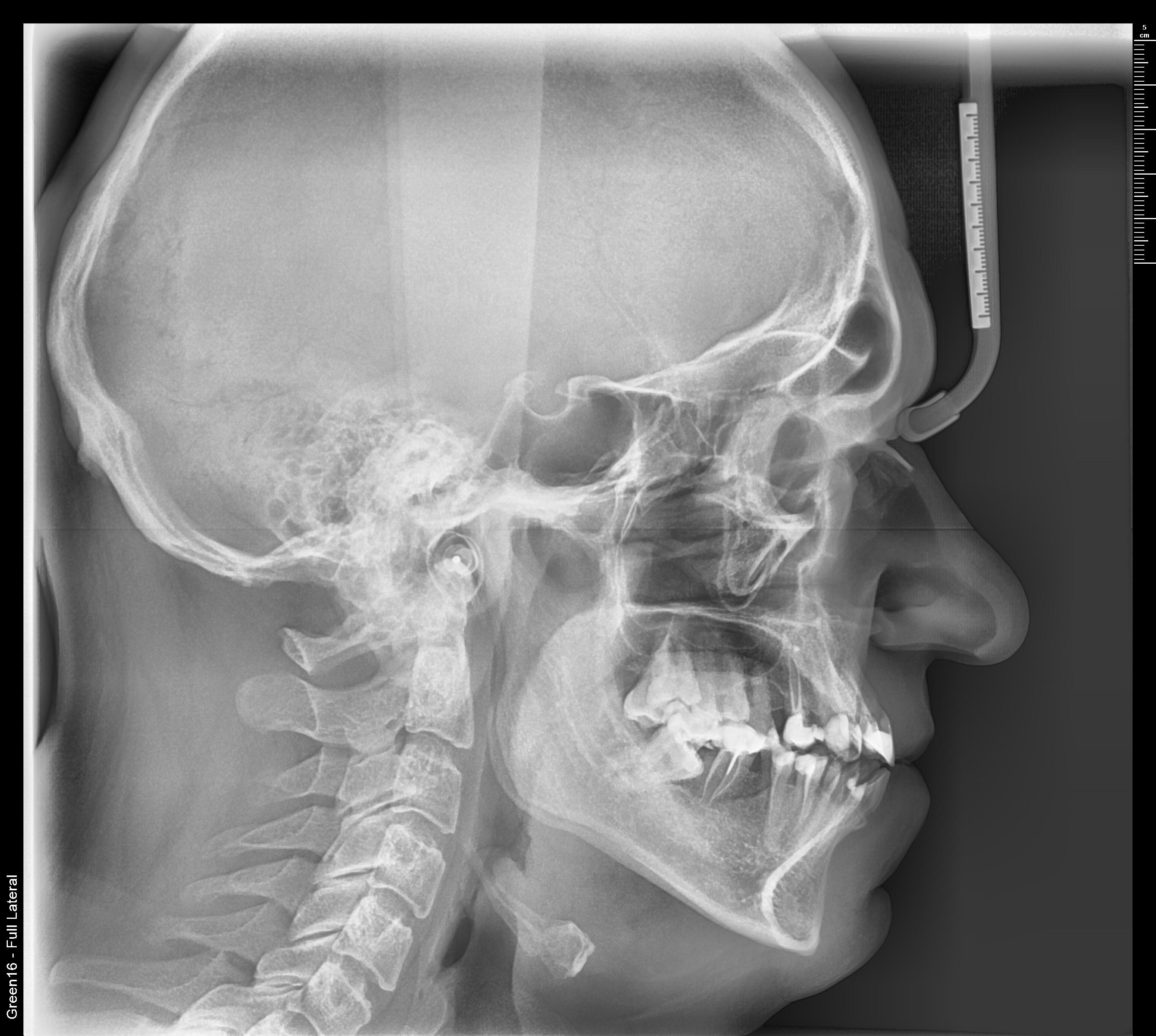 Телерентгенограмма (ТРГ) - Фото