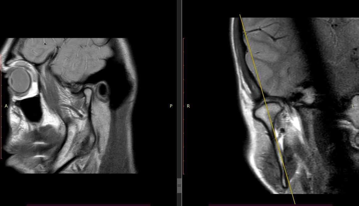 МРТ височно-нижнечелюстного сустава (ВНЧС) - Фото